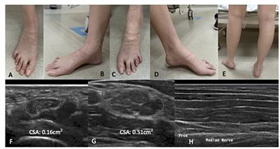 Acute to Subacute Atraumatic Entrapment Neuropathies in Patients With CMT1A: A Report of a Distinct Phenotypic Variant of CMT1A